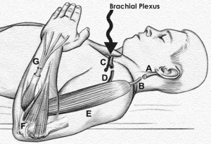 Types of Brachial Plexus Injuries and Their Treatment Methods