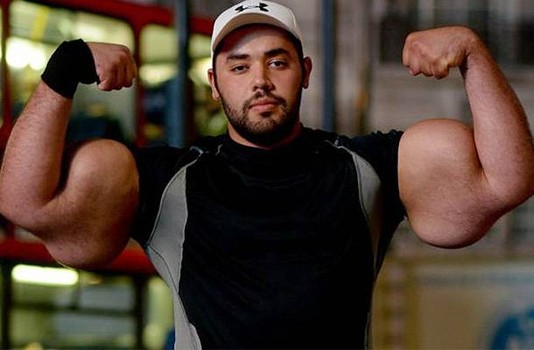 Injecting Synthol into Biceps Gone Wrong