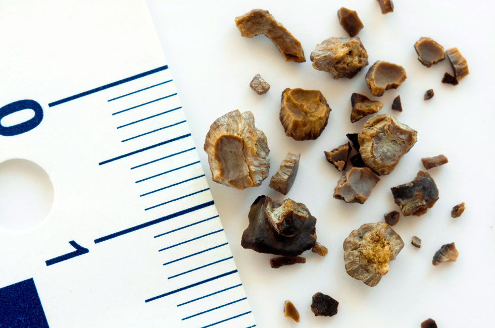 Foods to Avoid if You Are Suffering from Kidney Stones