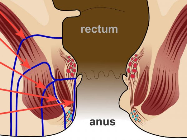 Laser Surgical Treatment is the Best Medication for Anal Fistula