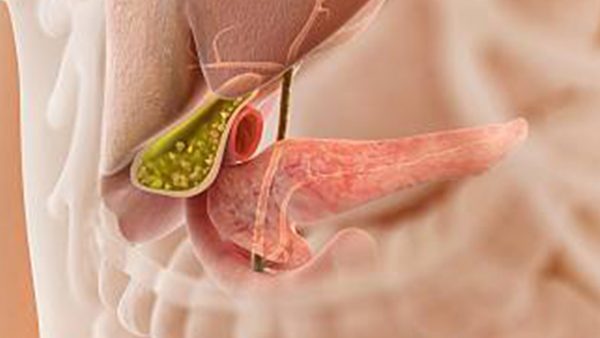 Is Surgery Necessary in Gallbladder Stone Treatment?