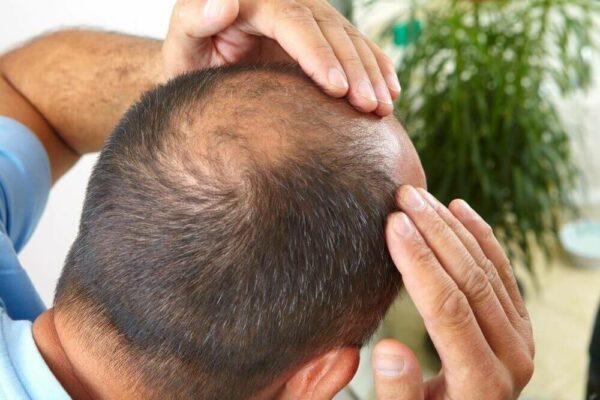 Symptoms and Causes of Alopecia Areata