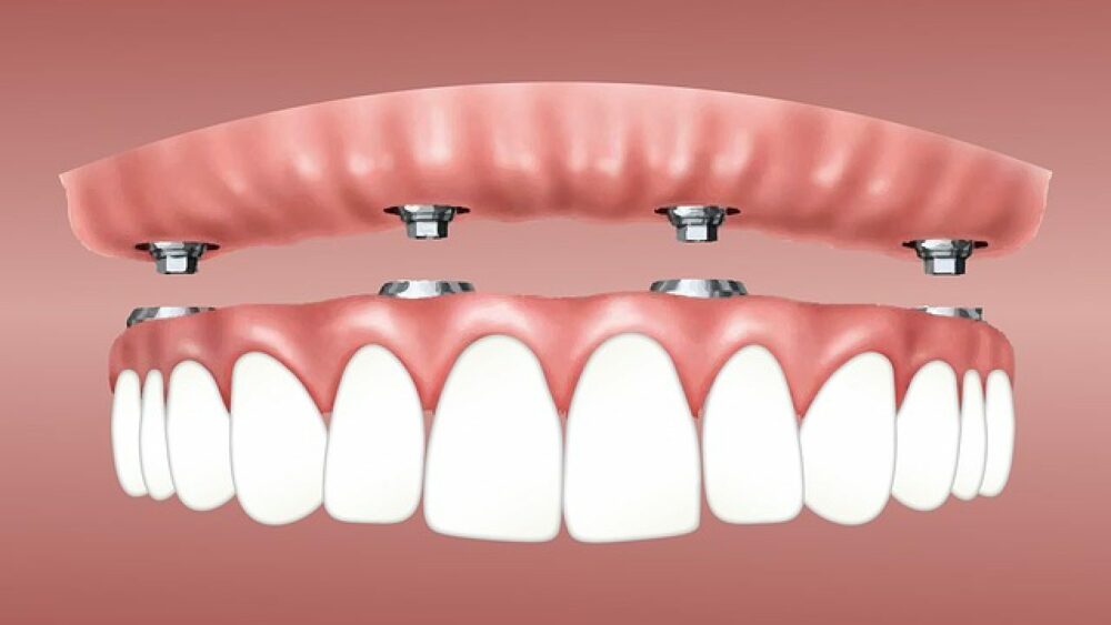 Dental implant