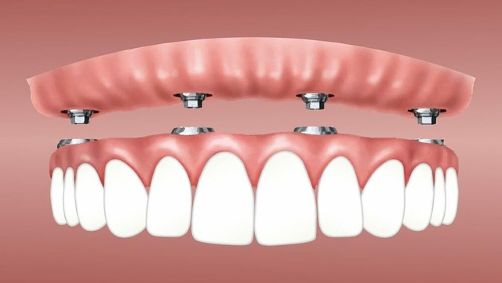 Dental implant