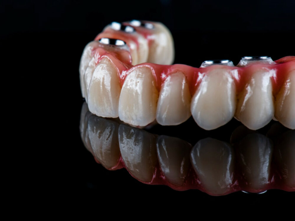 Dental implant bridge